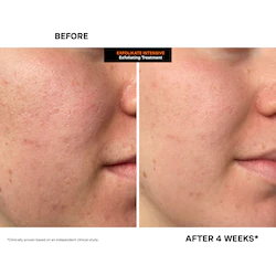 Kate Somerville Mini ExfoliKate® Intensive Pore Exfoliating Treatment