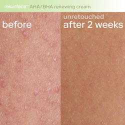 Skinfix Resurface+ AHA Renewing Body Cream