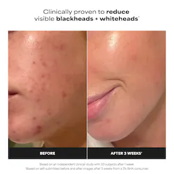 Paula's Choice Mini Skin Perfecting 2% BHA Liquid Exfoliant