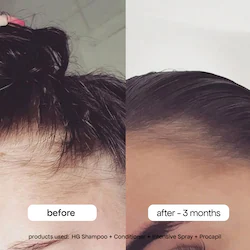BondiBoost Intensive Scalp Spray for Thinning Hair