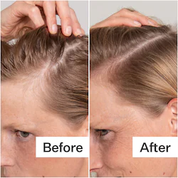 Act+Acre Salicylic Acid Scalp Renew Exfoliator For Oily + Flakey Scalp