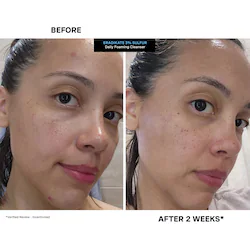 Kate Somerville Mini EradiKate™ Daily Cleanser with Sulfur Acne Treatment