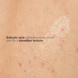 The Ordinary Salicylic Acid 0.5% Body Serum Exfoliating Treatment for Acne