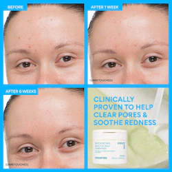 innisfree | Daily Korean Gentle Retinol + Salicylic Acid Soothing Toner Pads for Acne-Prone Skin​