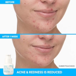 innisfree Gentle Retinol + Salicylic Acid Acne Serum for Blemishes + Post-Acne Scars​