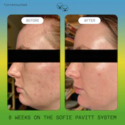 SOFIE PAVITT FACE Clear Skin Trial Set: Cleanse, Treat, & Hydrate Minis Set