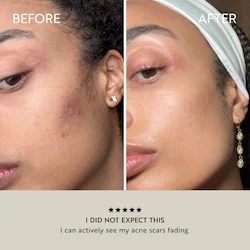 Katini Skin Clarity Purifying face oil serum for dark spots and blemishes + Tsubaki