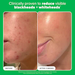 Paula's Choice Complexion Clarity Duo with Salicylic Acid & Azelaic Acid