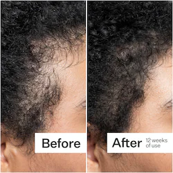 Act+Acre Scalp Dermastamp for Visibly Thicker + Fuller Hair