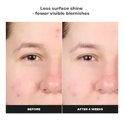 Paula's Choice Skin Perfecting 4% BHA Advanced Exfoliating Serum Toner